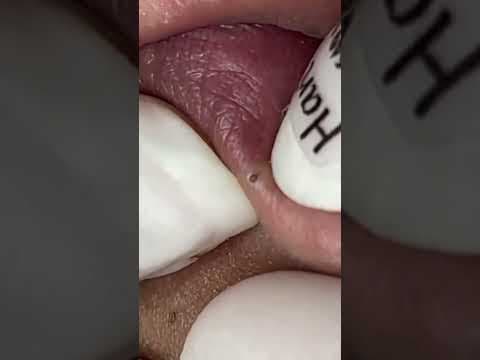 YouTube thumbnail for Blackhead extraction around the lips