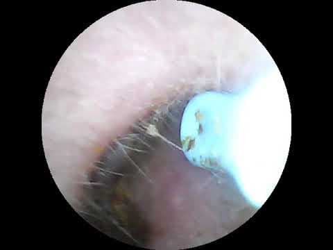 YouTube thumbnail for (OC) Giant earwax clump I finally got out