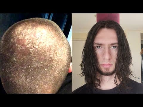 YouTube thumbnail for Man shows the health of his hair and scalp after not using any shampoo for 7 years